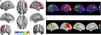 Cortical Structural Connectivity Alterations and Potential Pathogenesis in Mid-Stage Sporadic Parkinson’s Disease